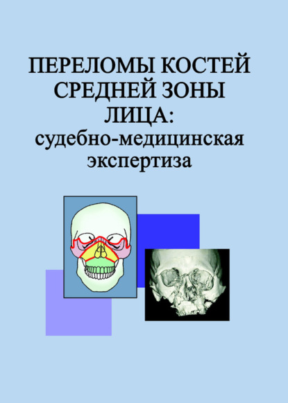 Книга Л. Н. Гришенкова, Людмила Николаевна Гришенкова, Федор Александрович Горбачев, Светлана Леонидовна Анищенко Переломы костей средней зоны лица: судебно-медицинская экспертиза