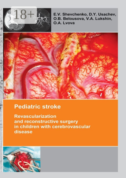 Книга E. V. Shevchenko, V. A. Lukshin, D. Y. Usachev, O. B. Belousova, O. A. Lvova Pediatric stroke. Revascularization and reconstructive surgery in children with cerebrovascular disease
