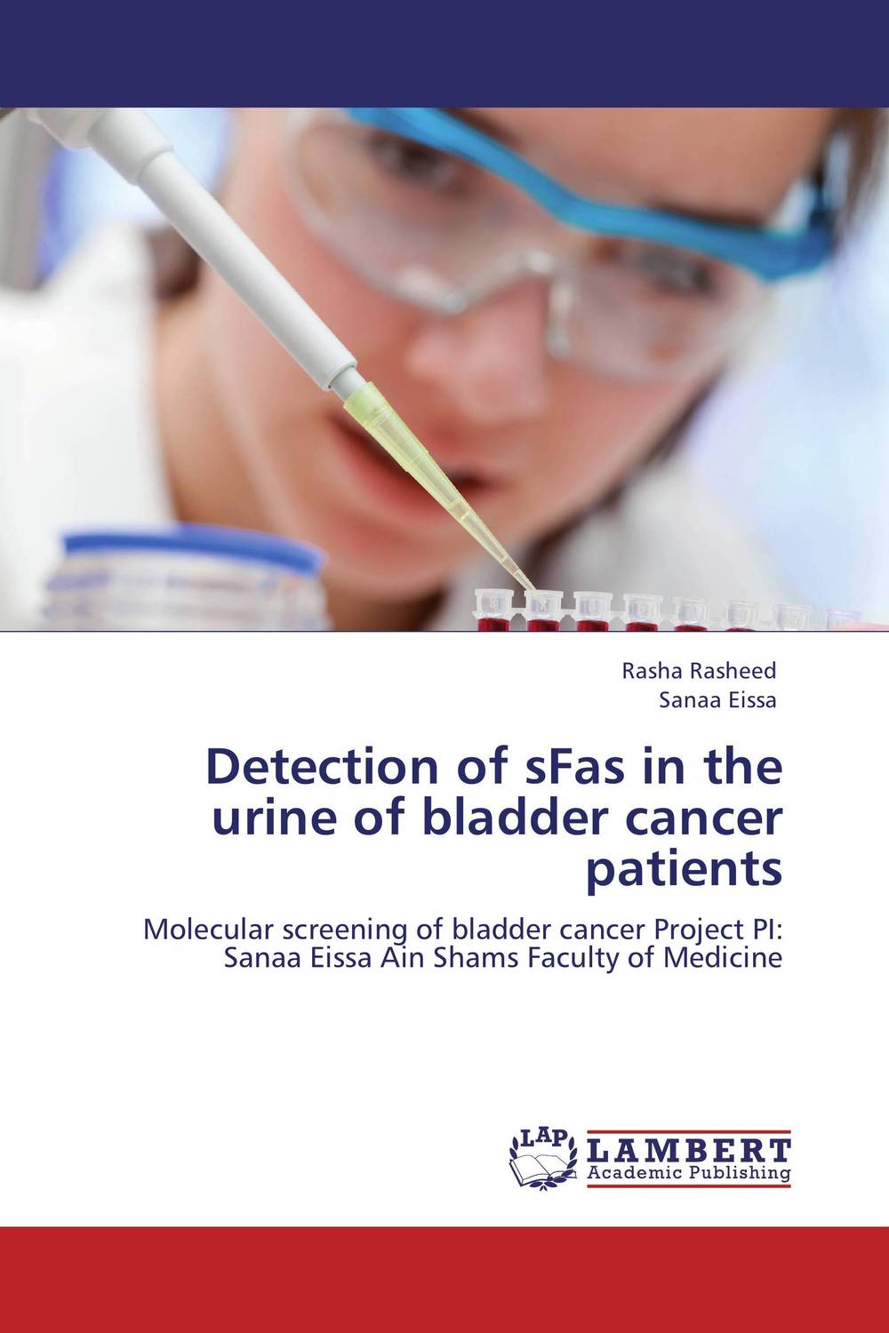 Detection of sFas in the urine of bladder cancer patients