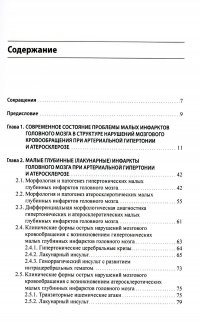 Малые инфаркты головного мозга