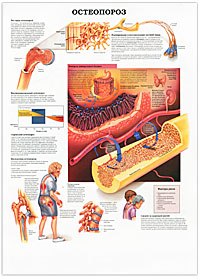 Остеопороз. Паркинсонизм. Плакат