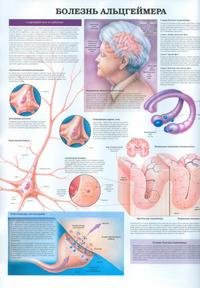 Болезнь Альцгеймера. Эпилепсия. Плакат