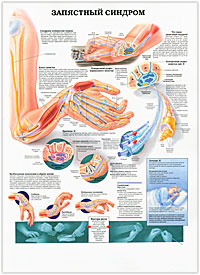 Запястный синдром. Травмы колена. Плакат