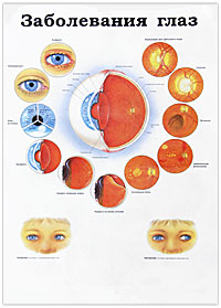 Значение холестерина. Заболевания глаз. Плакат