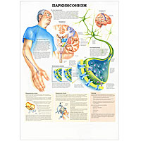 Болезнь Альцгеймера. Паркинсонизм. Плакат