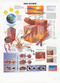 Рак кожи. Рак. Плакат